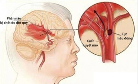 Đột quỵ não là gì? Nguyên nhân, dấu hiệu, cách xử lý khi phát hiện người thân bị đột quỵ