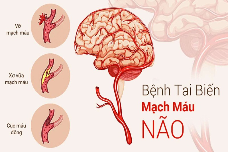 Tai biến mạch máu não: Nguyên nhân, biểu hiện, cách phòng tránh