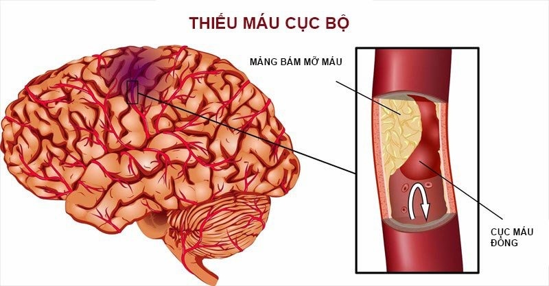 Tổng hợp nguyên nhân gây tai biến mạch máu não bất kì ai cũng nên biết