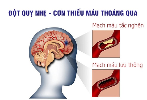 Cơn thiếu máu não thoáng qua (TIA): Coi chừng đột quỵ