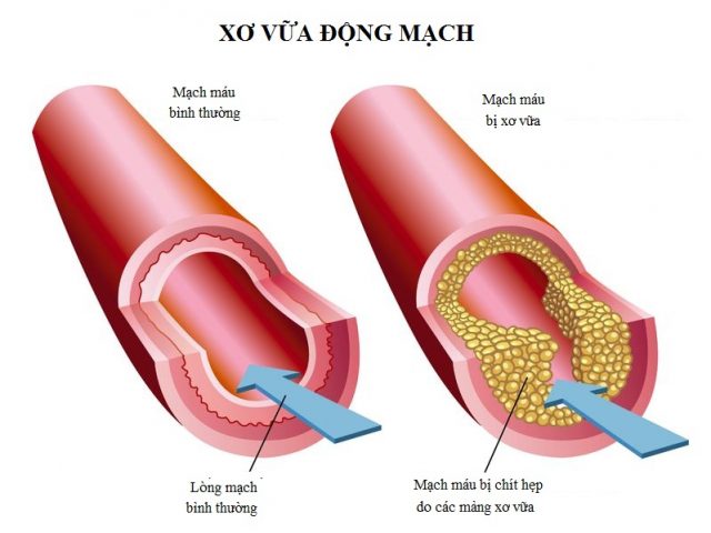 Cách phòng xơ vữa động mạch ngăn ngừa đột quỵ và bệnh tim mạch