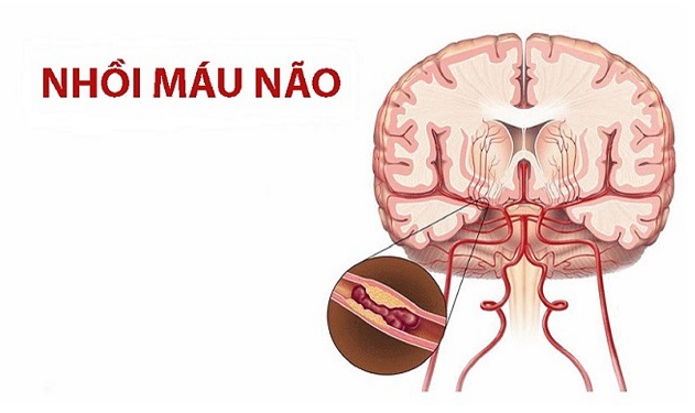 Đột quỵ nhồi máu não: Nguyên nhân, biểu hiện, cách phòng ngừa