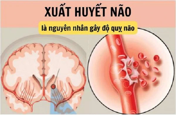 Khi nào nên phẫu thuật xuất huyết não? Lưu ý quan trọng từ bác sĩ chuyên khoa