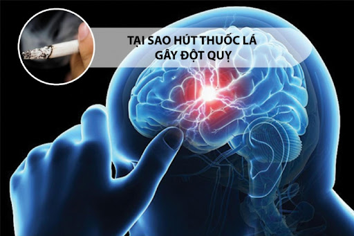 Hút thuốc lá làm tăng nguy cơ đột quỵ: Lý giải từ bác sĩ chuyên khoa