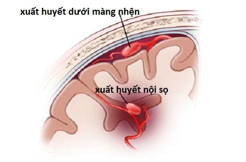 Xuất huyết dưới nhện: Nguy cơ đột quỵ tử vong không báo trước