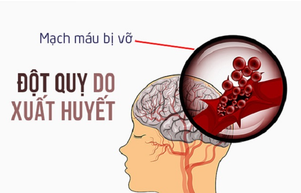 Giãn mạch máu não: Tìm hiểu nguyên nhân, biểu hiện, cách phòng ngừa